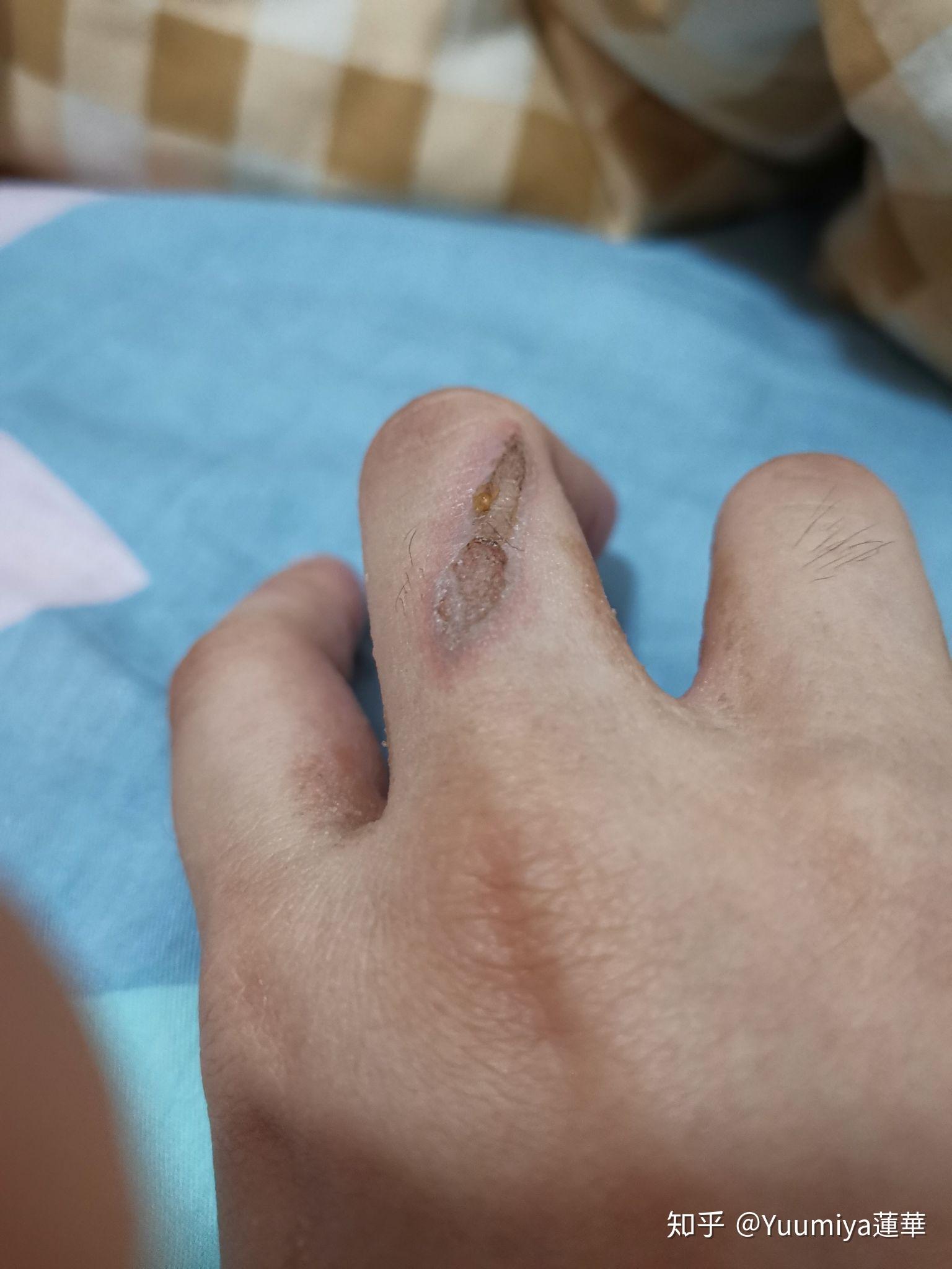 被电烙铁烫伤是一种什么样的体验?怎么处理不易留疤?