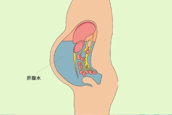 唐跃良腹腔积液的治疗方法