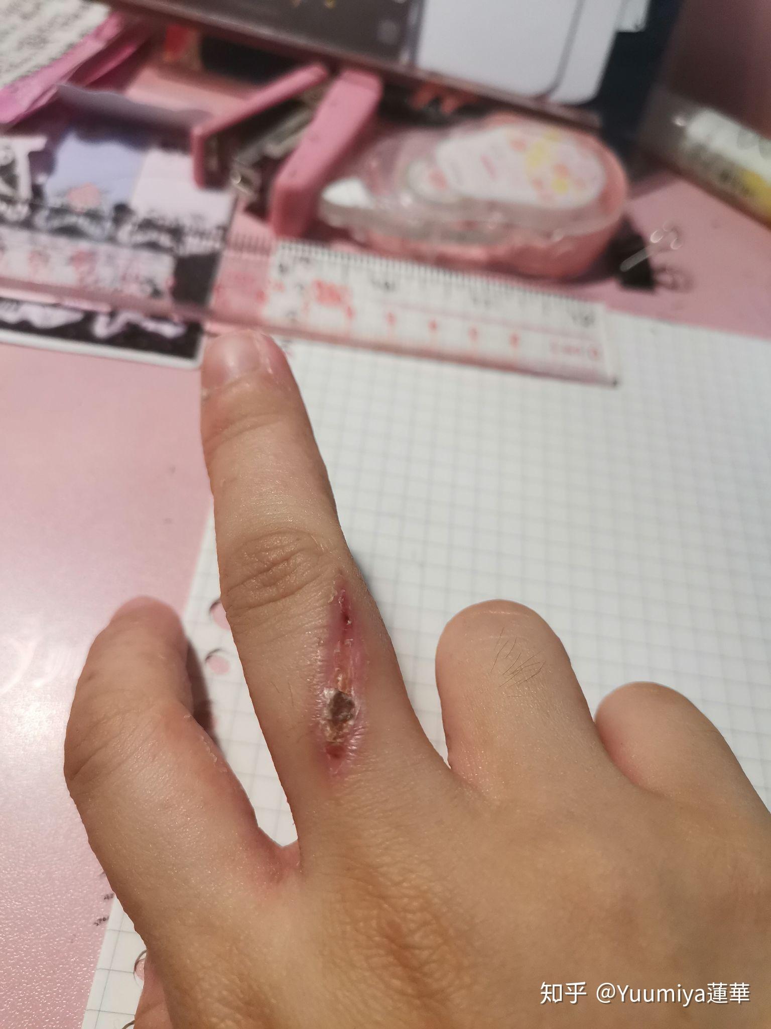 被电烙铁烫伤是一种什么样的体验?怎么处理不易留疤? - 知乎