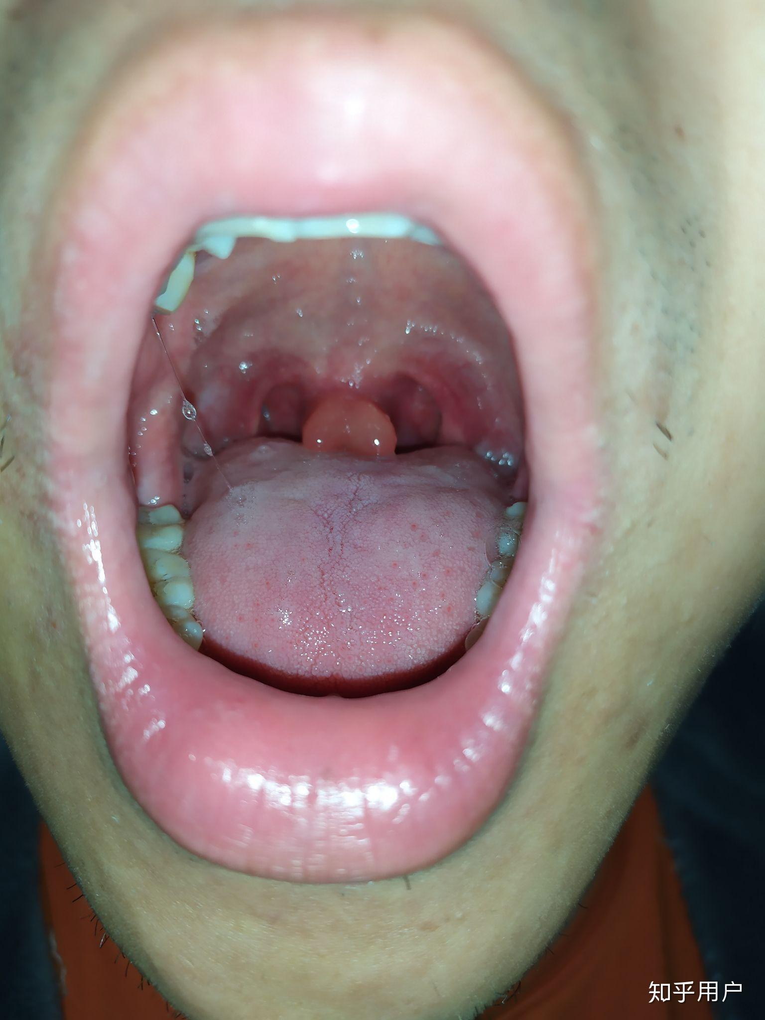 为什么会有鼻涕擤不出来吸不回去堵在鼻孔深处让人无法呼吸