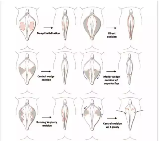 女性私密整形手术有哪些存在哪些风险要注意什么