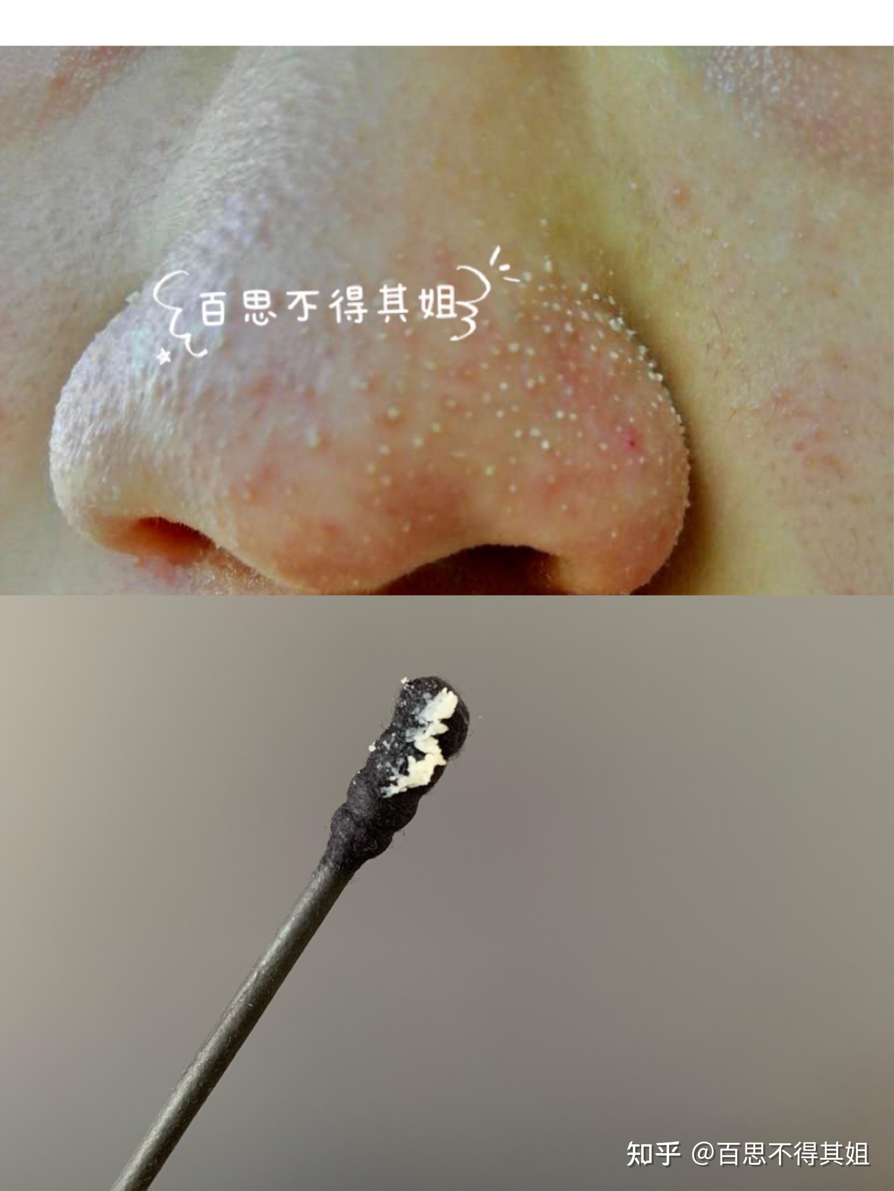 黑头很严重,不想去美容院,有没有什么办法? - 知乎