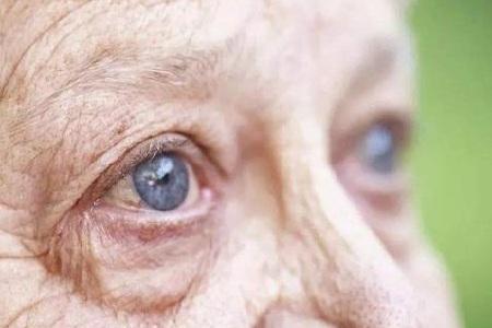 首大聂红平老年性白内障分哪些种