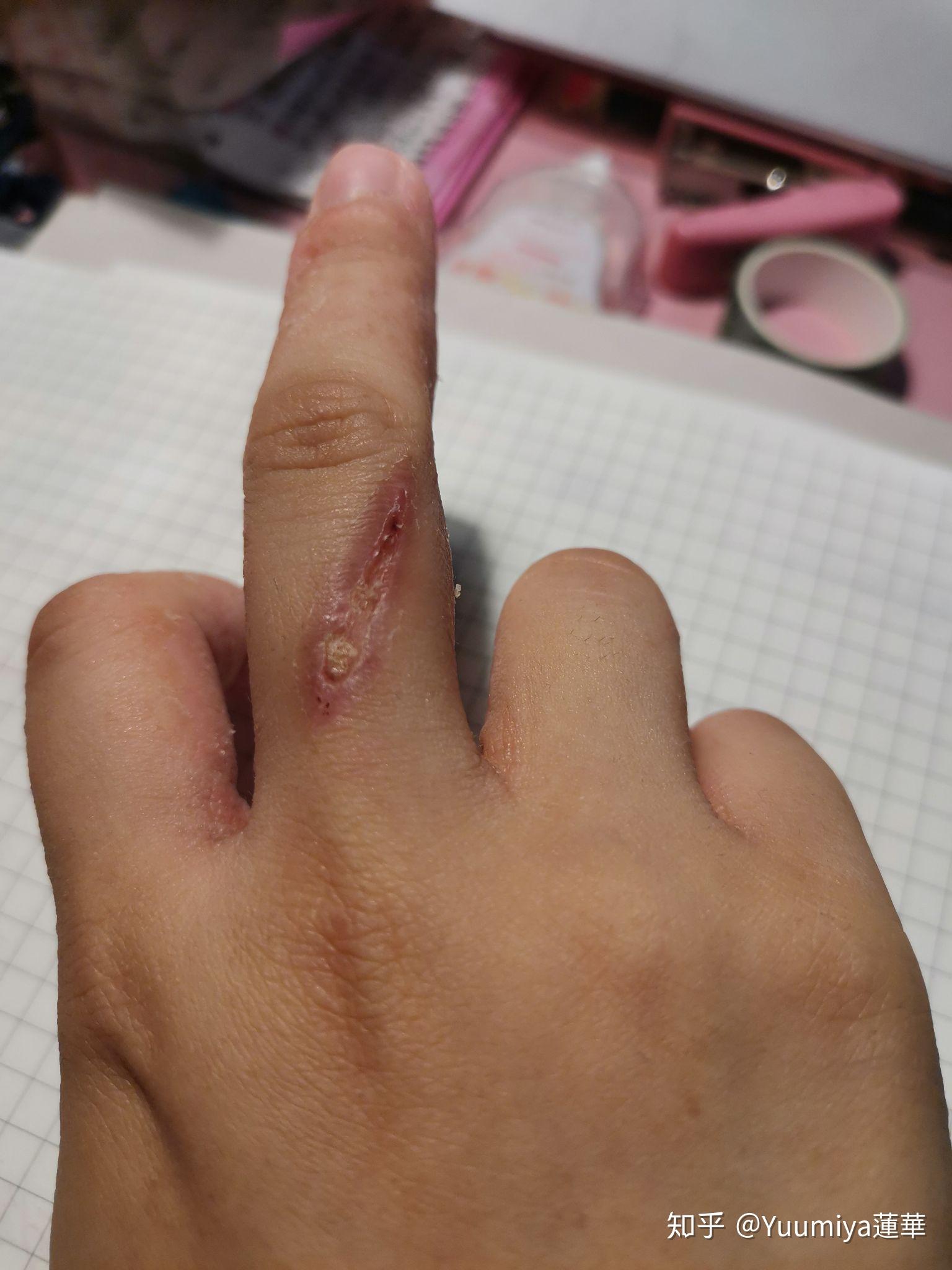 被电烙铁烫伤是一种什么样的体验?怎么处理不易留疤?