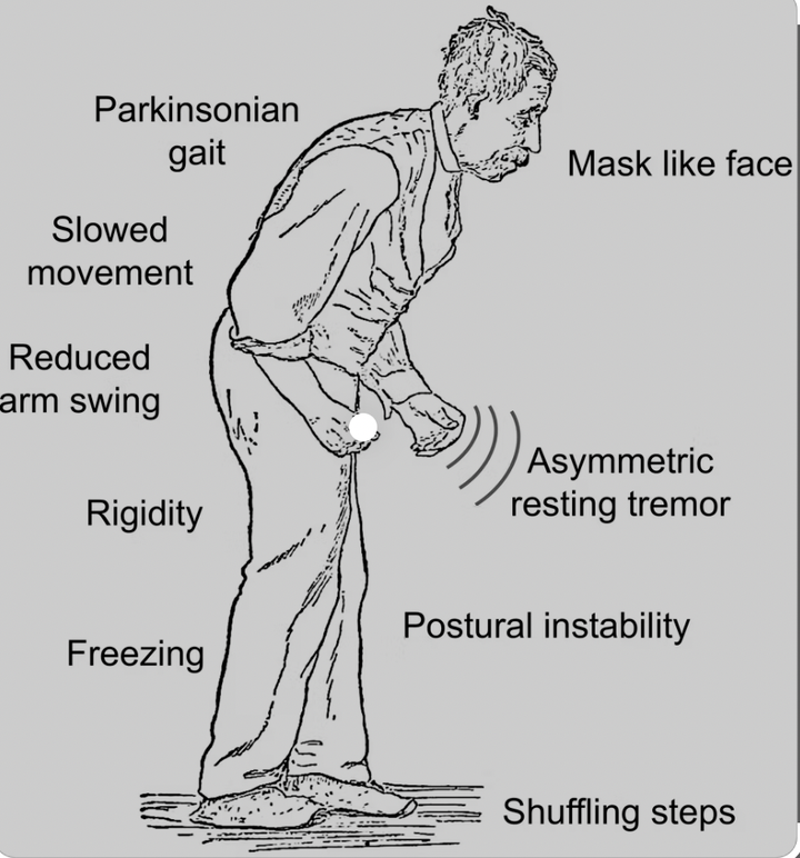 医学思维导图神经内科如何诊断帕金森? 知乎
