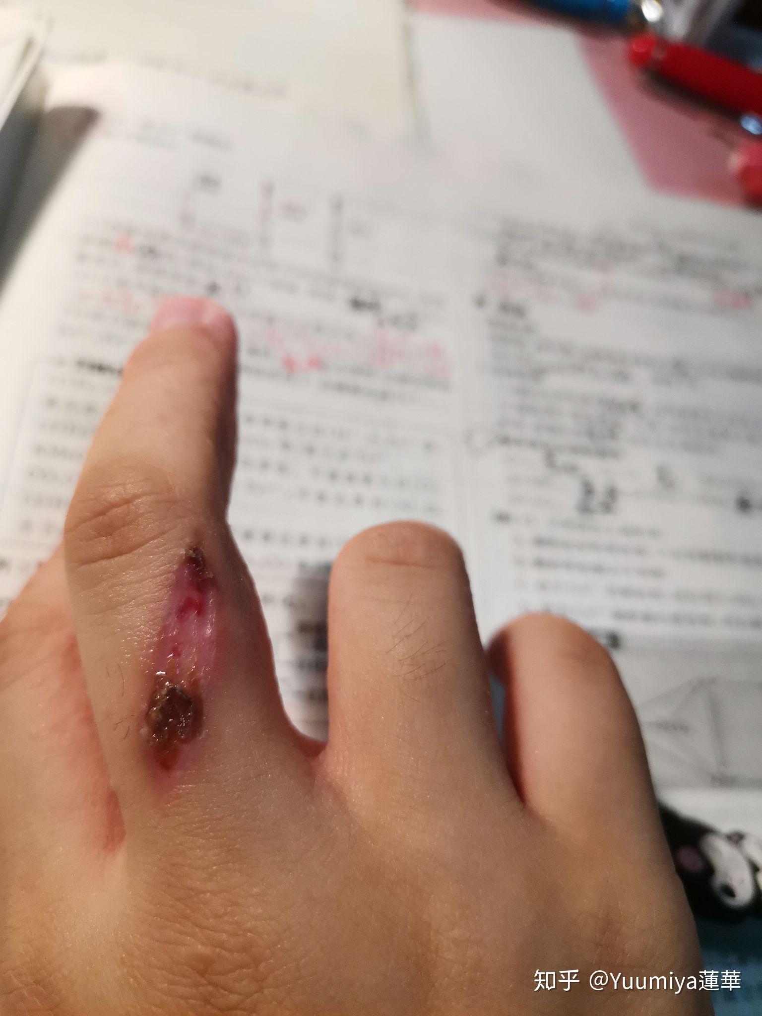 被电烙铁烫伤是一种什么样的体验?怎么处理不易留疤?