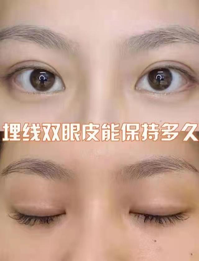 埋线双眼皮能够维持多久呢
