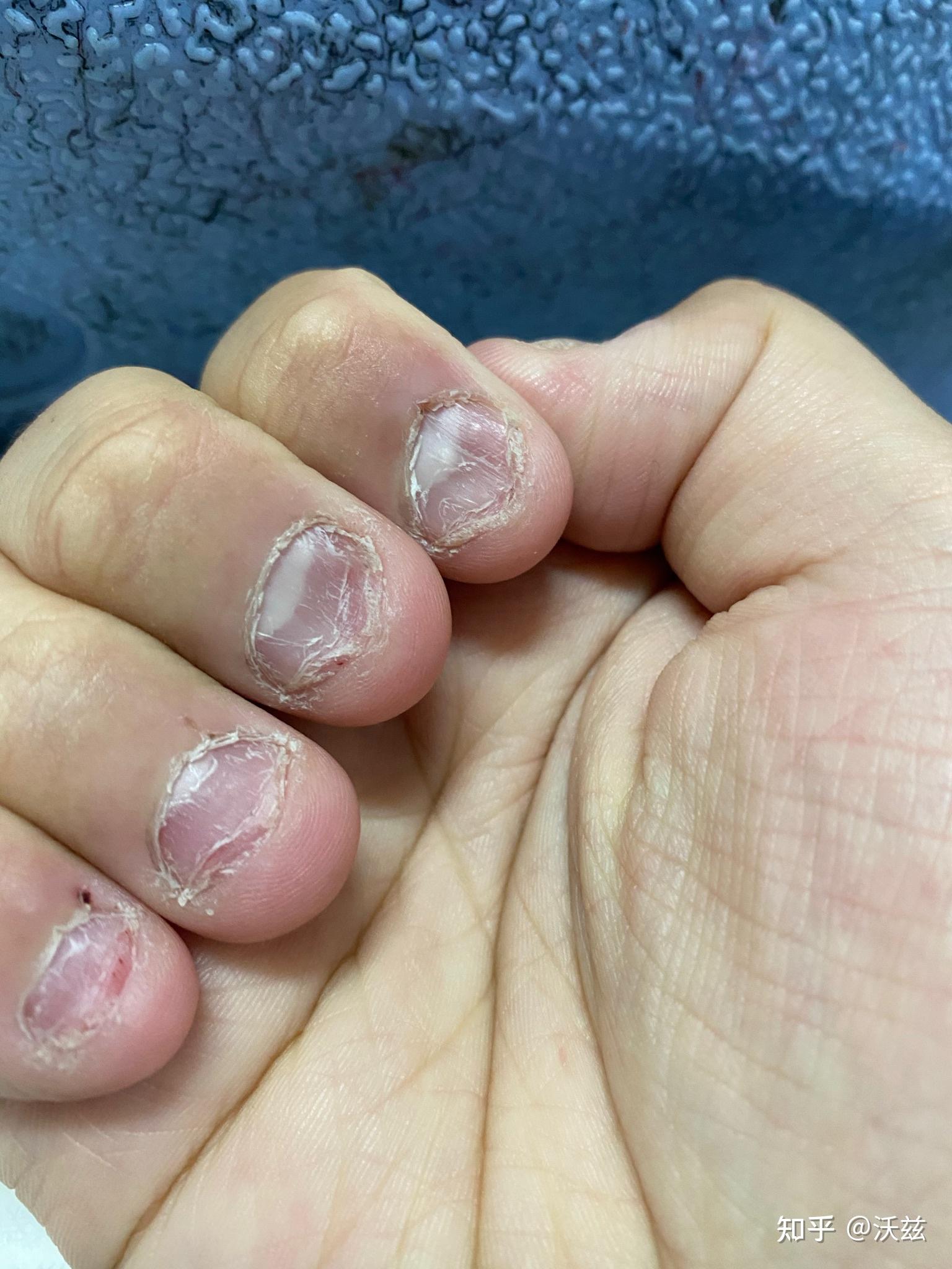 吃手能有多严重?