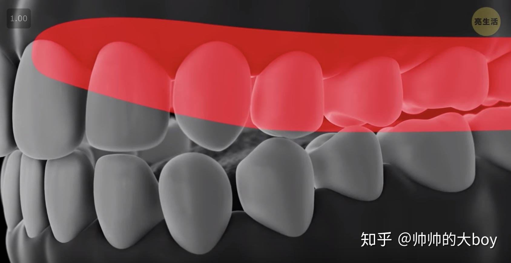 3D打印+舌刺-矫正器-云南家红齿科技术股份有限公司