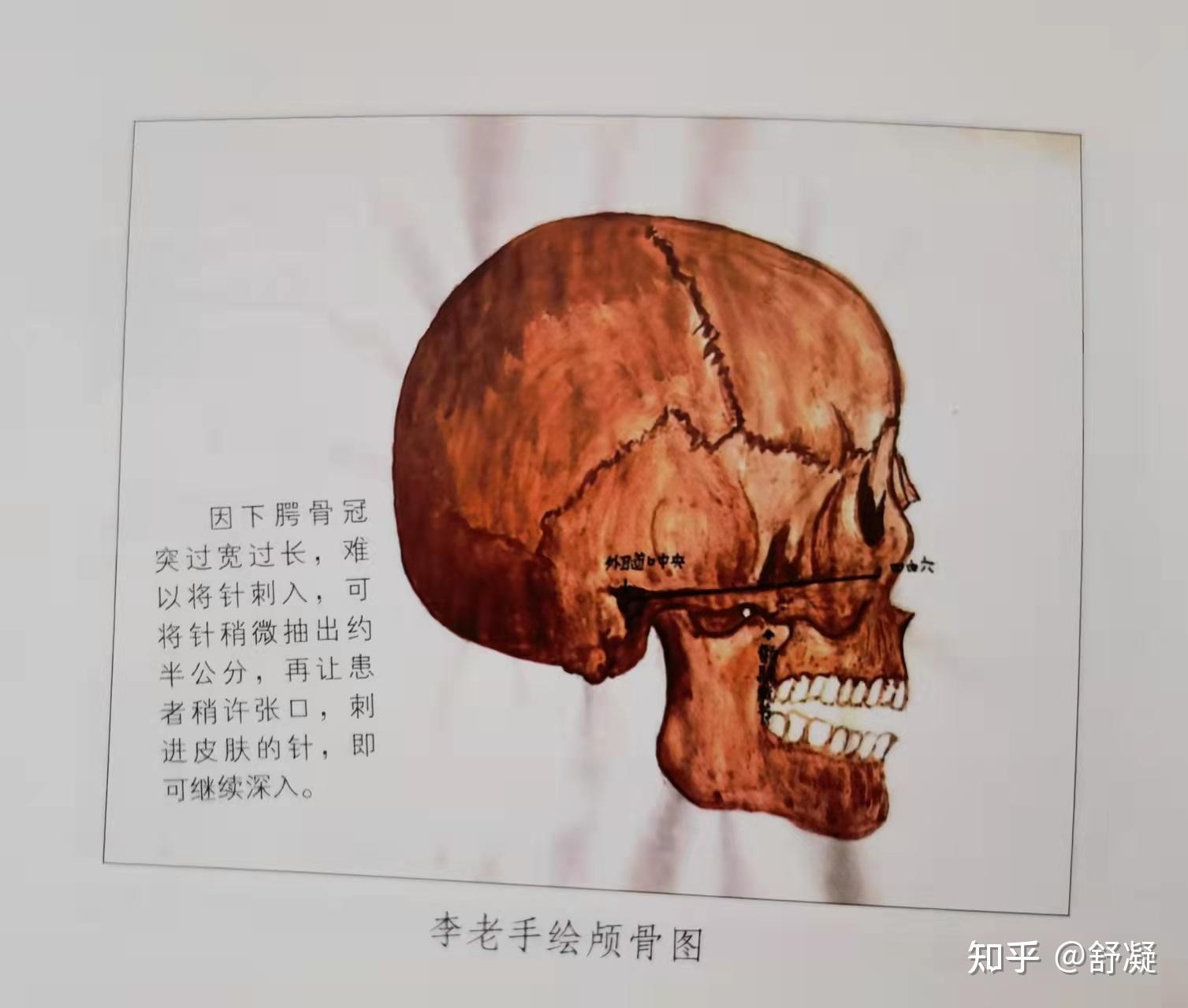 张笑天：颧骨内推手术对高颧骨有效果吗_凤凰网健康_凤凰网