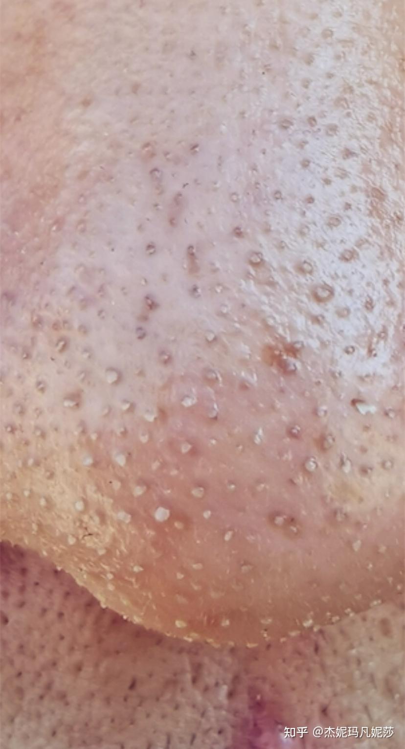 洗完脸毛孔很小过一会变得很油毛孔也变大而且有脏东西怎么办