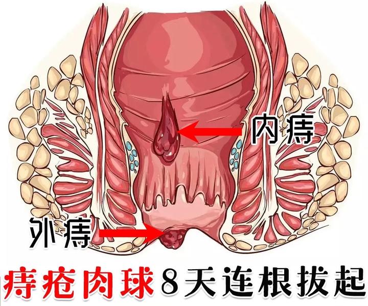 怎么让脱出的肉球缩回去